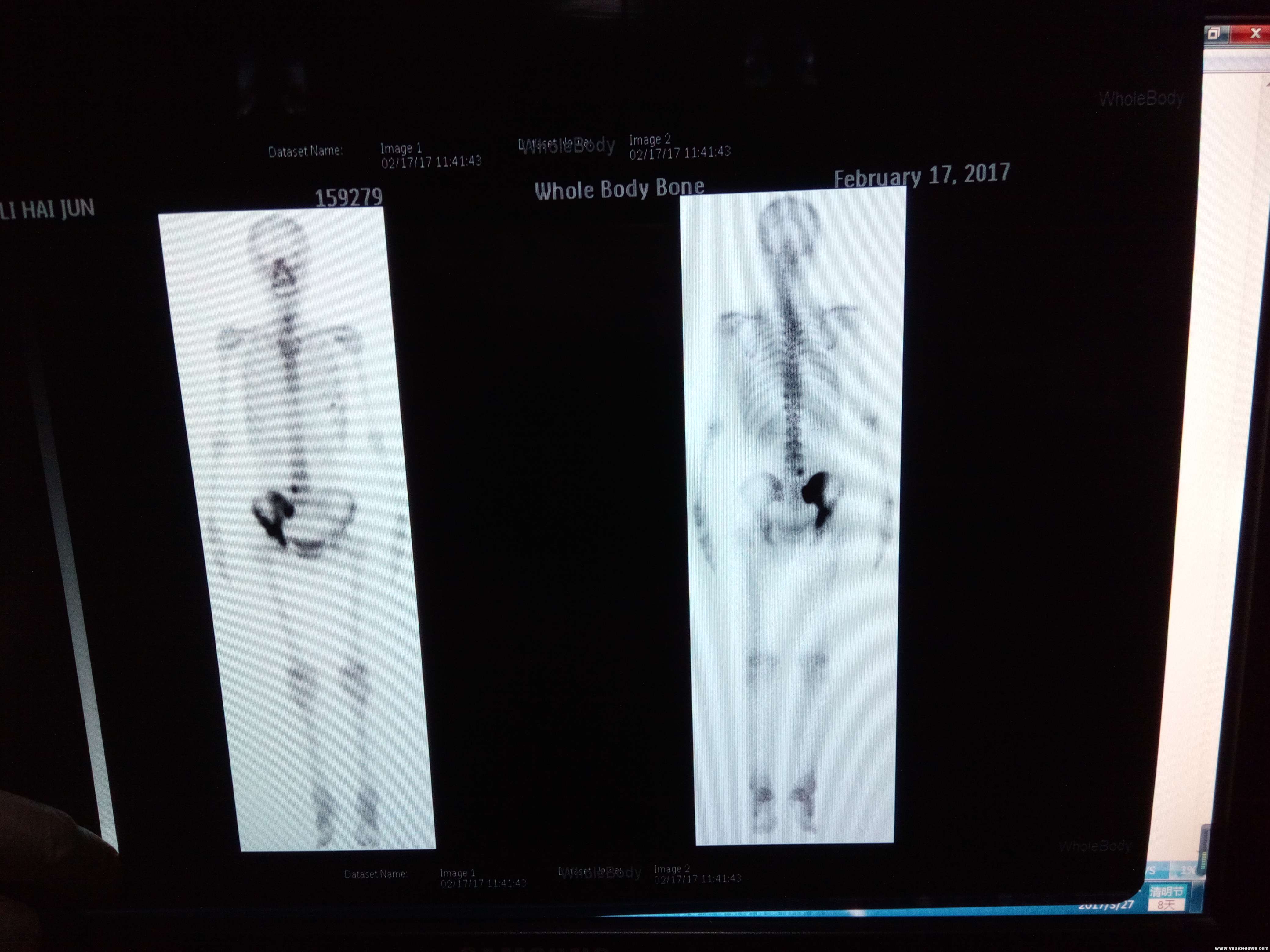 17年2月骨扫描